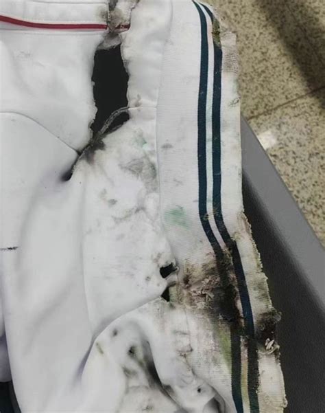 13岁男孩被硫酸灼伤广州地铁致歉