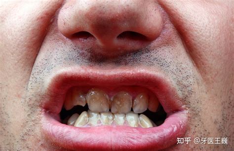 40岁牙周炎牙齿全掉光了怎么办