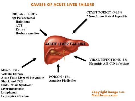 causes of acute liver failure