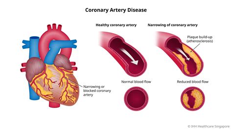 coronary artery disease影响因子