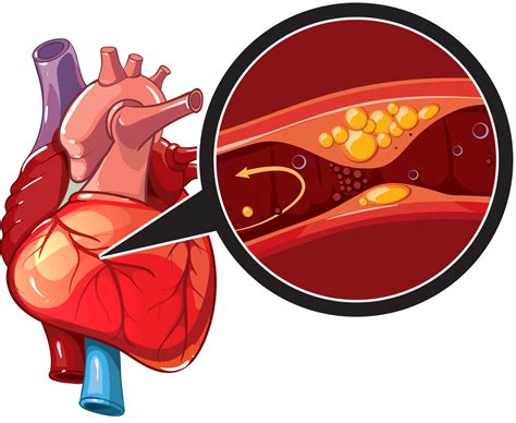 coronary heart disease影响因子