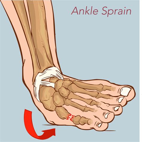 sprain the ankle